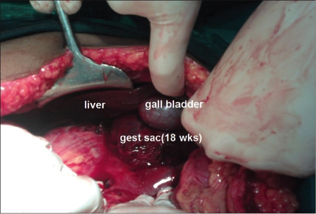 Description: D:\CHỬA TRONG Ổ BUNG- MỚI\HÌNH CHỬA GAN 2.jpg