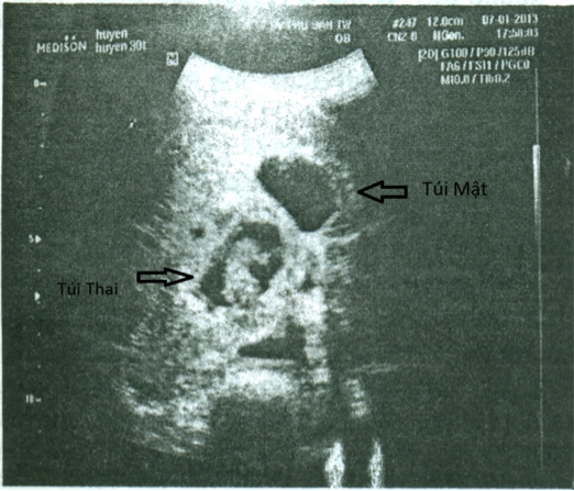 Description: G:\SA trong gan.png