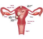 endo_uterinepolyp