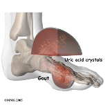 general_gout