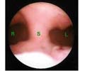 hysteroscopy_1