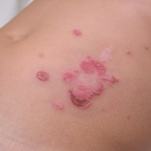 impetigo