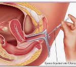 iui