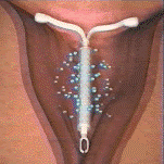 levonorgestrel