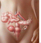 ovarian02