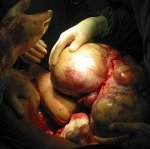 ovarian_cancer_2