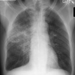 rul-pneumonia-pa