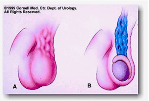 varicocele