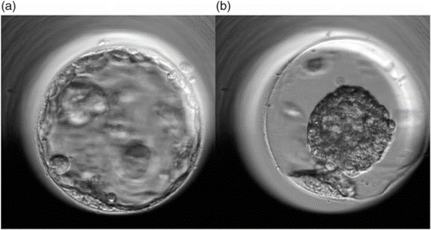 Sự khác biệt về hình thái và tiên lượng lâm sàng giữa hiện tượng Contraction và Collapse ở phôi nang