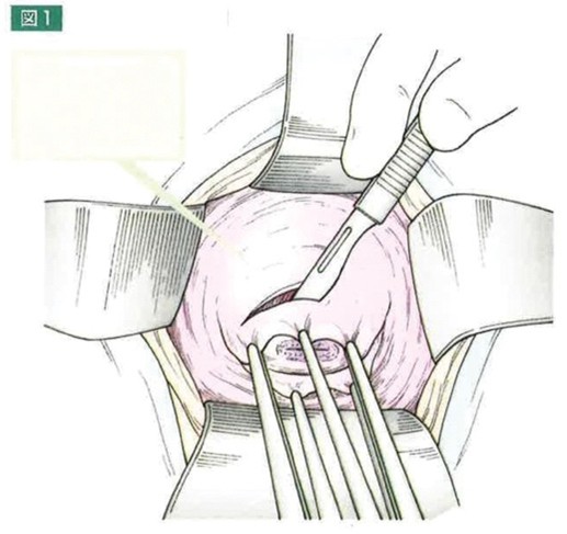 Bảo tồn chức năng sinh sản ở bệnh nhân ung thư cổ tử cung giai đoạn sớm