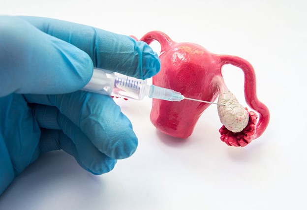 Kích thích buồng trứng trước điều trị ung thư: thách thức, tính an toàn và lựa chọn phác đồ