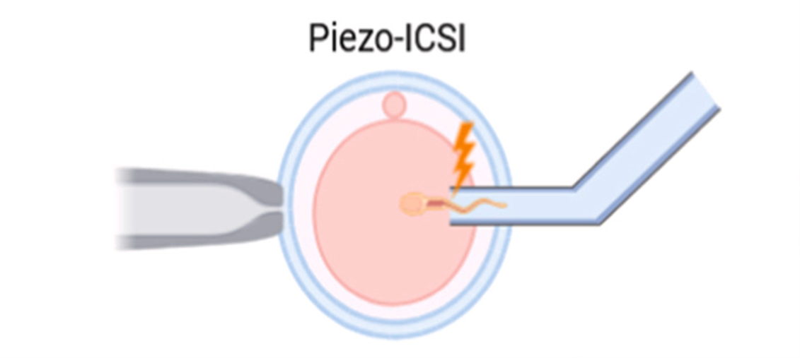 Hiệu quả của Kỹ thuật Piezo-ICSI trong hỗ trợ sinh sản